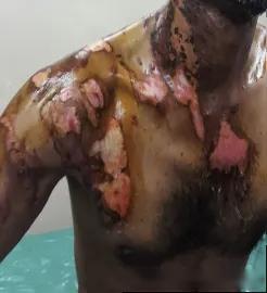 DIPHOTERINE敵腐特靈溶液印度塔拉普爾工業區化學灼傷效果評估1